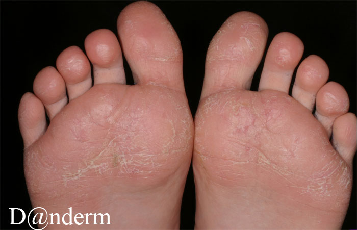 2-108-35_Atopic_winter_feet_in_children_(Also_in_large_size)