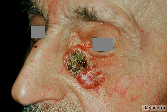7-95-1_Basal_cell_carcinoma_nodular_ulcerated