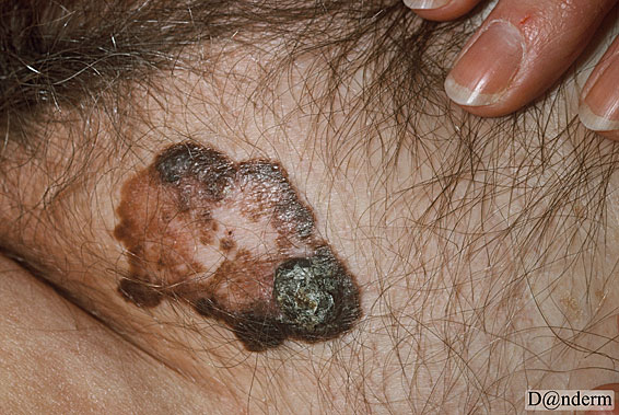 7-167-6_Malignant_melanoma_nodular