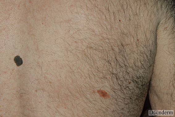 7-159-3_Malignant_melanoma_superficial_spreading_and_basal_cell_carcinoma_(1_of_2)