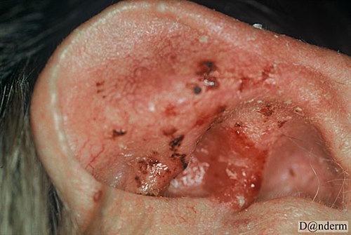 7-119-5_Squamous_cell_carcinoma_on_the_ear