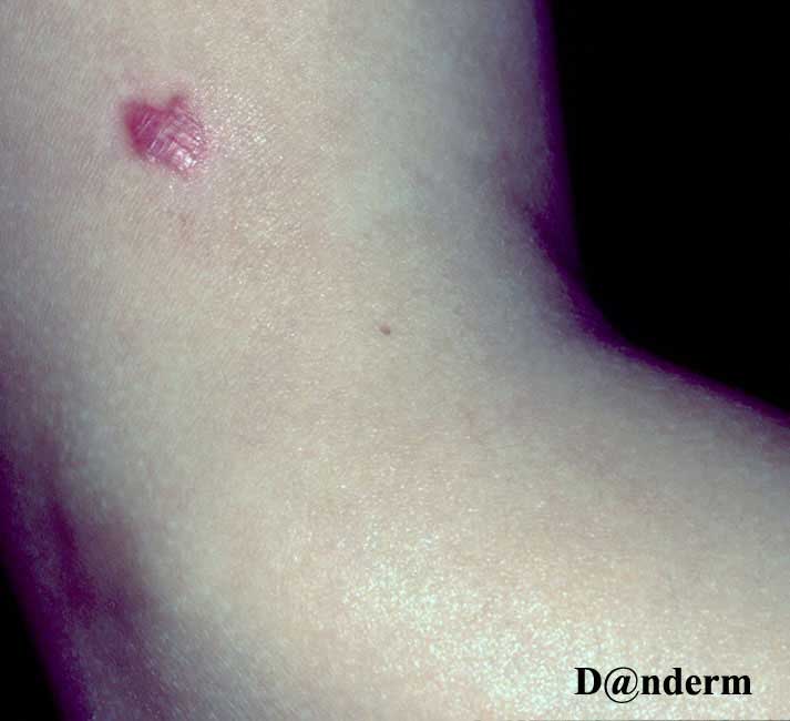 7-156-1_Spitz_naevus_(juvenile_melanoma)_(1_of_2)