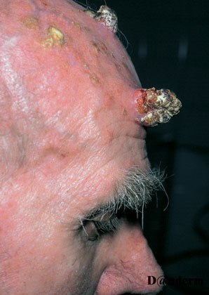 7-124_Cutaneous_horn_caused_by_a_squamous_cell_carcinoma