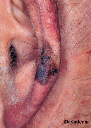 7-156_Lentigo_maligna