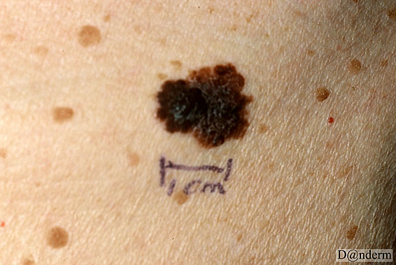 7-167-9_Malignant_melanoma_nodular