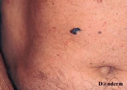 7-158_Malignant_melanoma_-_superficial_spreading_type_(1_of_2)