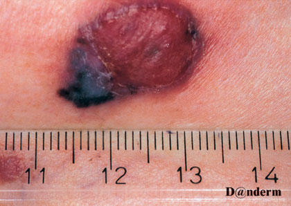 7-167_Malignant_melanoma_-_nodular