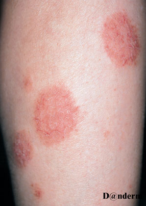2-123_Nummular_eczema_of_the_legs_(2_of_2)