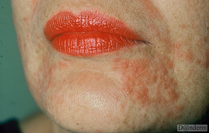 4-146-8_Periorificial_dermatitis