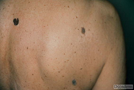 7-159-5_Malignant_melanoma_superficial_spreading_and_basal_cell_carcinoma_and_seborrhoeic_keratosis_(1_of_2)