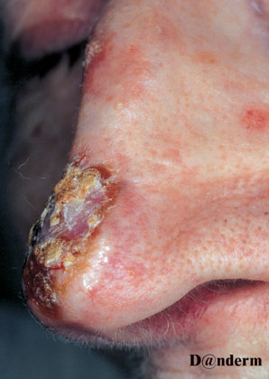 7-95_Basal_cell_carcinoma_-_ulcerated