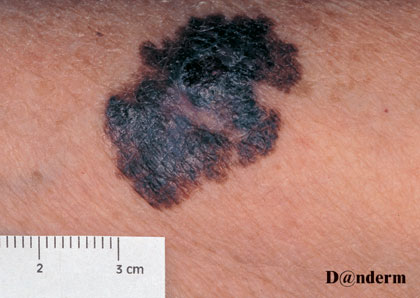 7-163_Malignant_melanoma_(2_of_2)