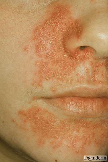 4-146-6_Periorificial_dermatitis