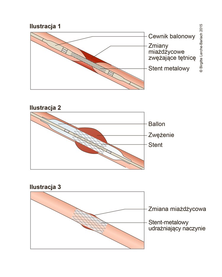 Ilustracja stentowanie zwężenia naczynia krwionośnego