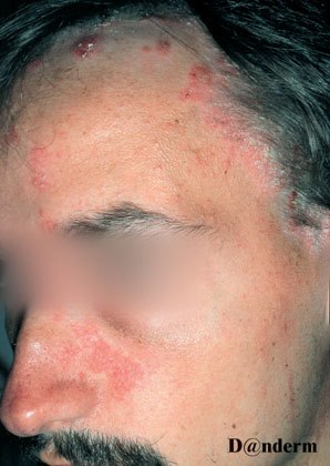 Twarz mężczyzny z łuszczycą twarzy i skóry owłosionej głowy