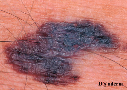 7-159_Malignant_melanoma_-_superficial_spreading_type_(2_of_2)