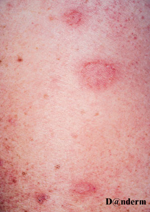 2-125_Nummular_eczema_of_the_arms_(1_of_2)