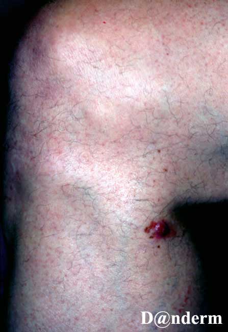 7-167-3_Malignant_melanoma_with_little_pigment_(1_of_2)